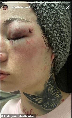 She had injuries to her cheek and eye