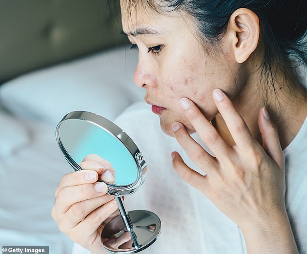 When the skin produces too much oil that clogs pores, bacteria can grow, leading to inflammation. The body's response to the bacteria sends white blood cells to the area, causing redness, swelling, and pus