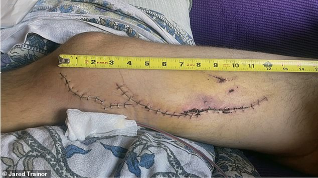 A man received stitches in his leg after a shark attack in Ferndale, California in 2022.