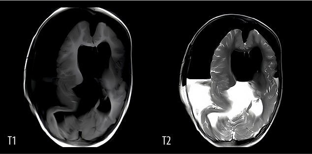 After the tissue was removed from the brain, the patient never recovered and succumbed to a series of severe seizures. The scans show her brain after the surgery