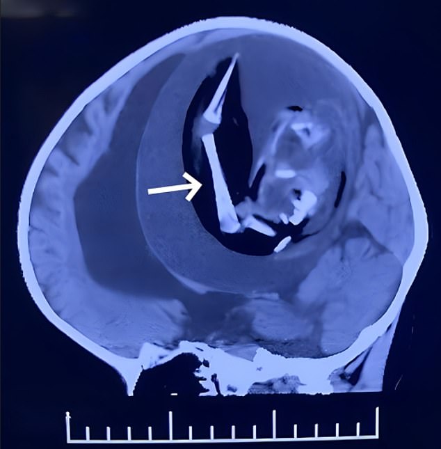 This scan, taken before the tissue was removed, shows the immature bones that the fetus contained within the child's skull. The white arrow on the scan points to them