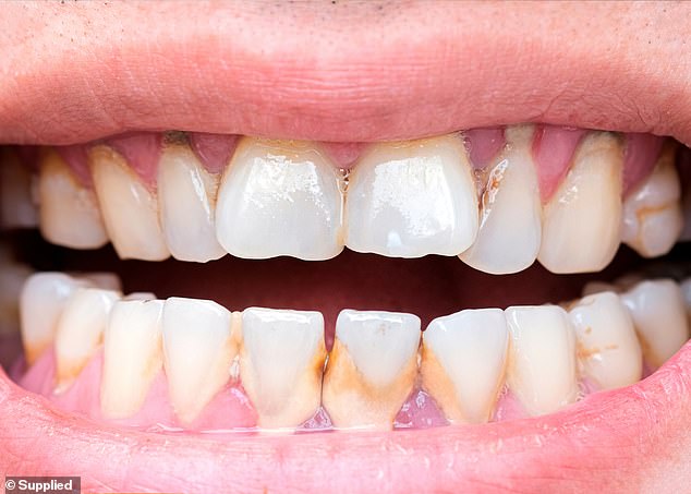 Using TikTok hacks is more likely to lead to serious dental problems in the long run, including permanently discolored and cracked teeth