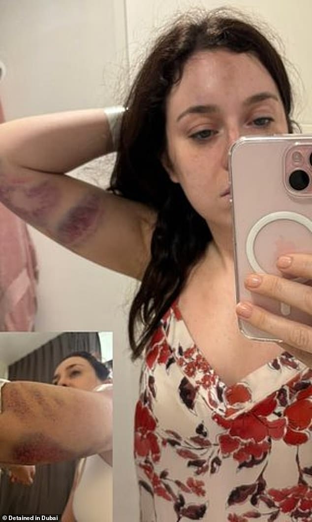 Tori Towey was photographed with extensive bruising over her body, which she says is the result of an attack