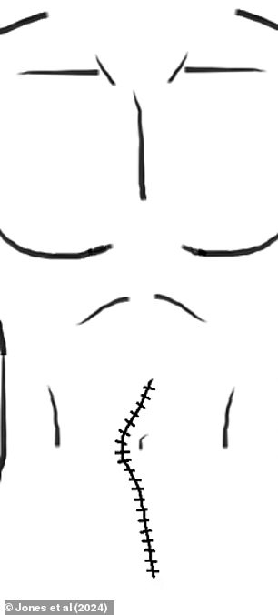 Above is an illustration from a Florida patient's case report, depicting the man's incision after doctors repaired his external surgery.