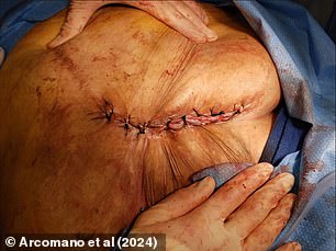 Surgeons were able to successfully place the woman's organs back into her body and close her wound