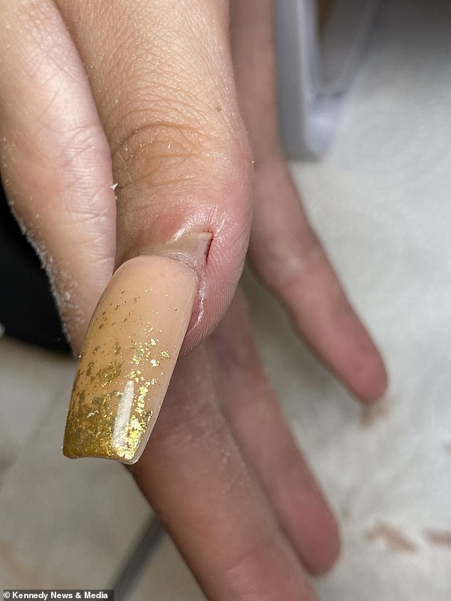 Ms Scott now believes that Laylah's infection was caused by the chemical methyl methacrylate (MMA) used by the original salon. The photo shows Laylah's acrylic nail after she had bumped it