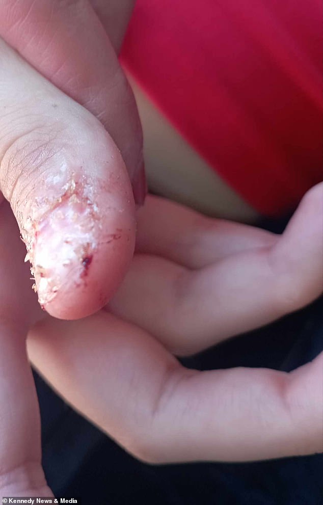 Ms. Scott claimed that when Laylah nicked her nails, her acrylic nails should have come off. However, the strong substance used caused her natural nails to come off instead of coming off.