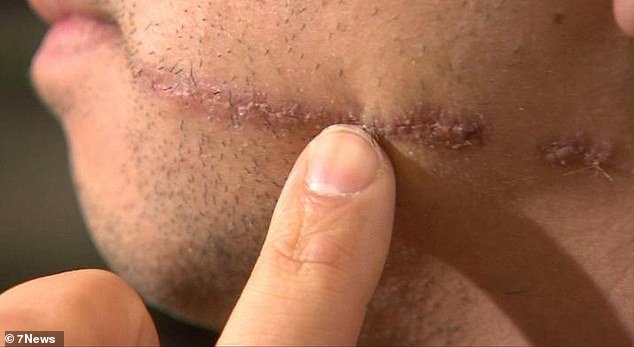 The partially healed cut on Mr. Munoz's cheek that required 30 stitches