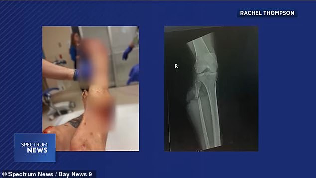 Doctors noticed that Thompson's leg was in poor condition and were concerned about a possible infection