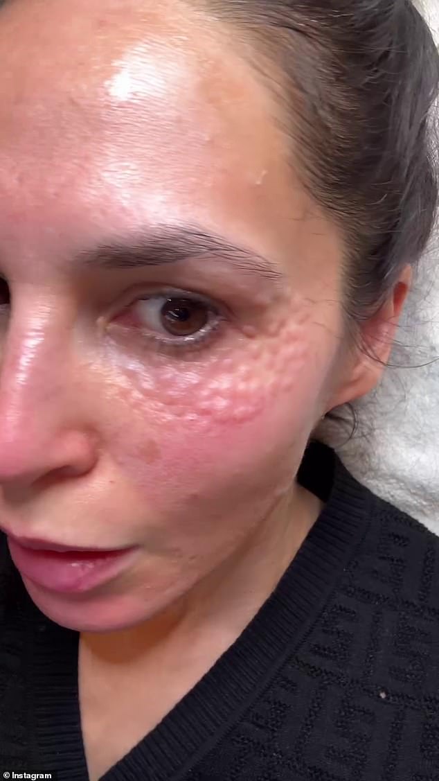 The 40-year-old gave her social media followers a good look at the skin under her eyes, which was dimpled, pockmarked and swollen