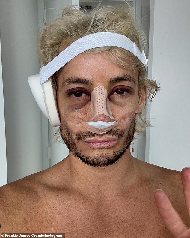 Last week, after Frankie posted a selfie of himself wrapped up in a bandage with a bruised face after a nose job, his famous sister commented under the Instagram photo