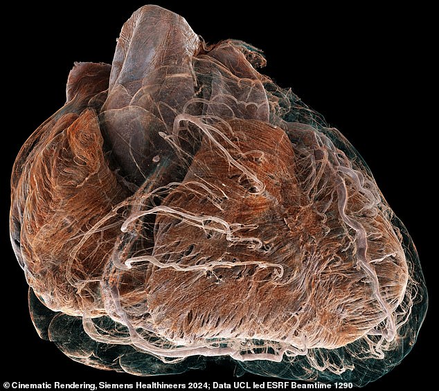 Diseased: This heart is from an 87-year-old white female donor with a history of ischemic heart disease