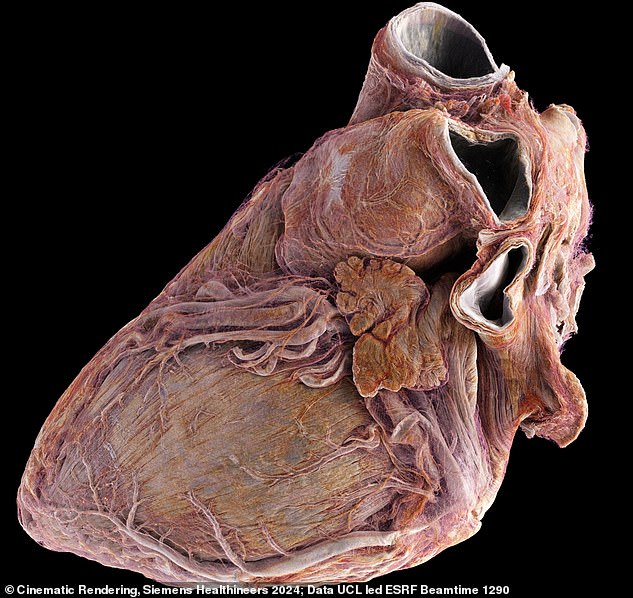 Healthy: Representation of a healthy male heart, showing external blood vessels and muscle fibers