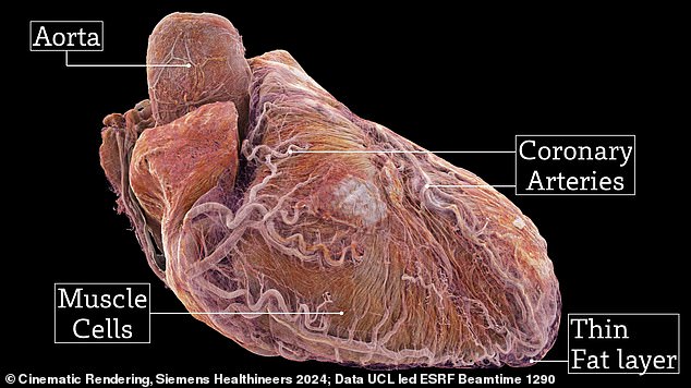 The healthy heart (pictured) came from a 63-year-old white male donor with no known heart problems