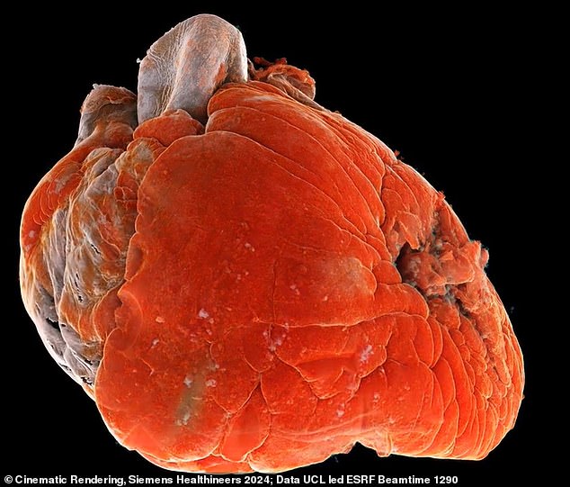 Sick: In addition to ischemic heart disease, the woman also had hypertension (high blood pressure) and atrial fibrillation (an irregular and often very fast heart rhythm)