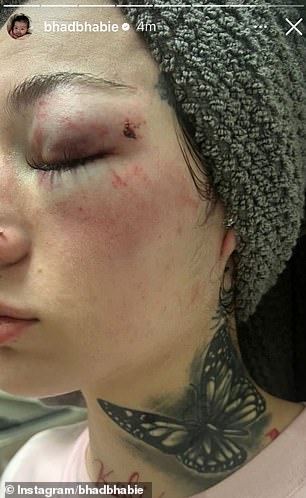 The 21-year-old rapper and OnlyFans star detailed the violence she says he subjected her to and the shocking injuries she says she sustained (pictured)