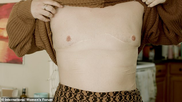 Parents were forced to have their children undergo mastectomy surgery. Pictured: the scars after such a procedure