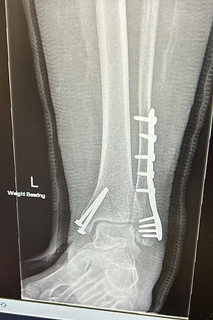 She broke her sternum and both ankles (pictured: screws in one of her ankles)