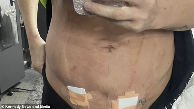 Not only did she experience complications from the procedure, she was also left with an unsatisfactory 'lump' on her abdomen