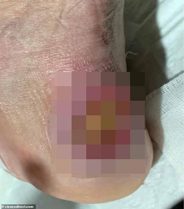 ‹ Slide me › When the patient checked into a hospital in Iran, the pressure sore on his heel—which was 7 cm long—had been there for about six months. But after three months of treatment, the sore had healed