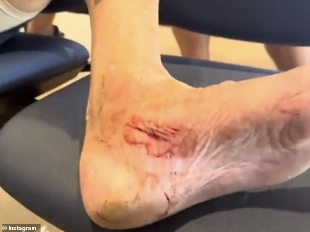 This week he was forced to drop anchor and go to Proserpine Hospital in Queensland after being hit by his own drone. In a social media post, Sam revealed his injured foot, which had been deeply cut when a gust of wind sent the device hurtling into him