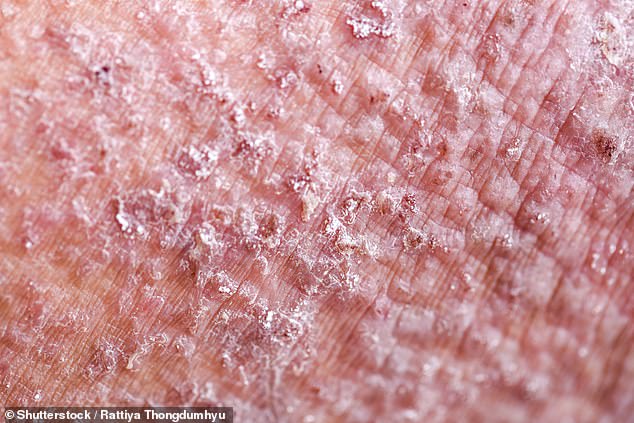 Pictured: A close-up of atopic dermatitis, also known as atopic eczema, one of the most common forms of eczema