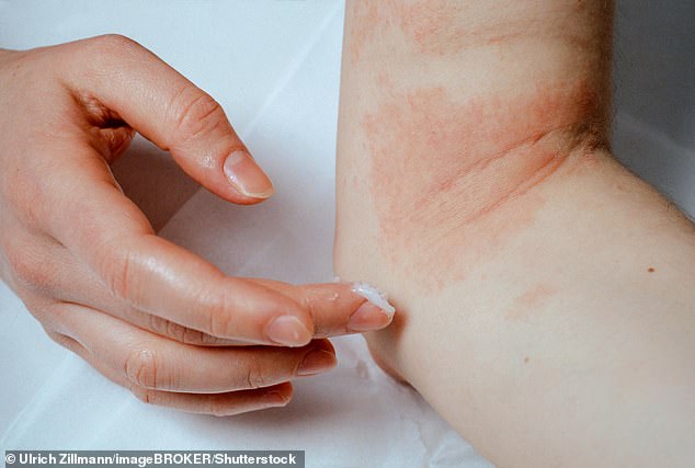 Pictured: A woman applying ointment to eczema on her elbow