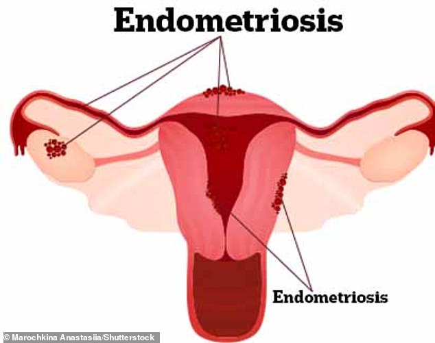 Endometriosis occurs when the lining of the womb grows outside the womb itself and affects one in ten women in the UK