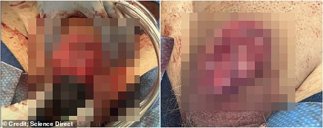 In photos too gruesome to show in full, doctors were forced to peel away the gangrenous penis flesh left over from the sex aid