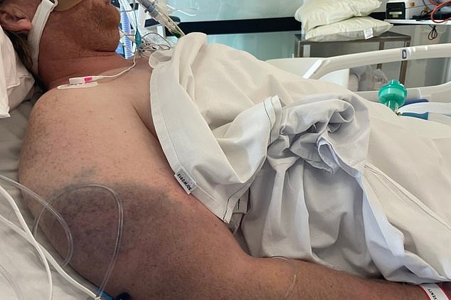 Mr Briggs (pictured in hospital) was in a coma for eight days