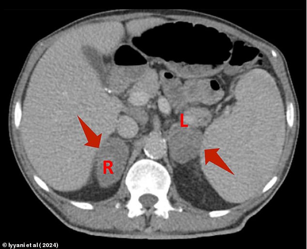 Above is an image of a body scan of the Florida patient, showing two masses on his adrenal glands as indicated by the arrows