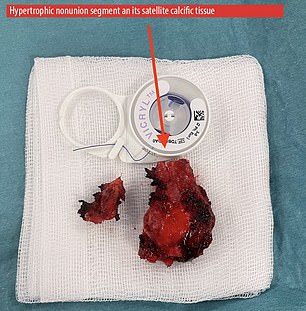 Chunks of bone tissue had formed a solidified mass between his broken bone. It was removed to relieve the pressure (pictured above)