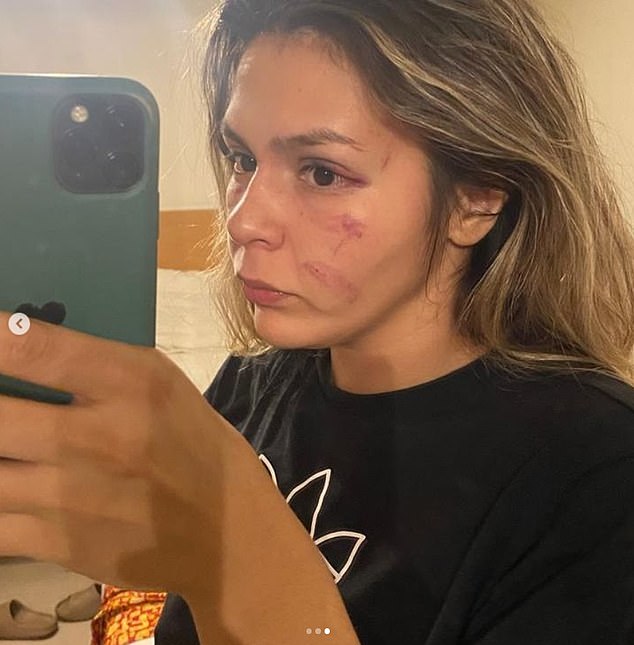 Brianda Tamara, who fought transgender boxer Imane Khelif in December 2022, posted these photos online showing her injuries after the match