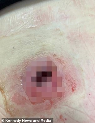 The abscess had to be surgically removed urgently, leaving a hole the size of a £1 coin and 2cm deep