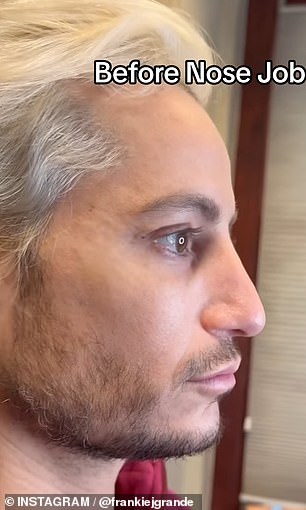 Ariana Grande's brother Frankie Grande, 41, took to social media to share before and after photos of his nose job; Seen in a before photo