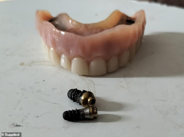 Mrs Glynn's entire top row of teeth had to be removed after the attack and she was fitted with implants, but the screws (pictured) that secured them to her jaw came loose just a year later