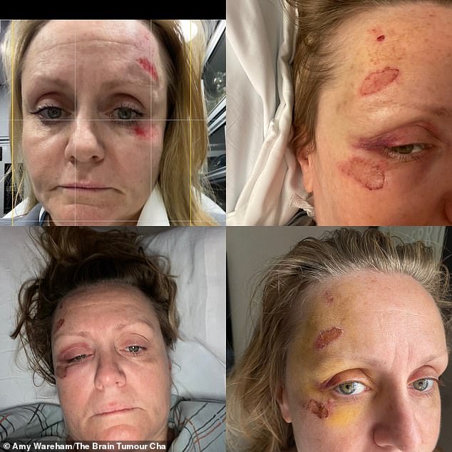 Mrs Wareham had no symptoms other than the headaches until she suffered an attack during a trip to New York last May, during which she fell and hit her face.