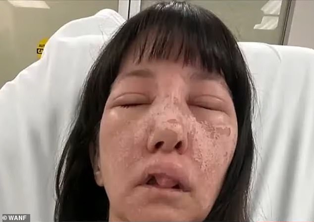 Jessica Rogue, 44, is still recovering from a bite to her face by brown recluse spiders while she was cleaning out a shed in her home on July 1