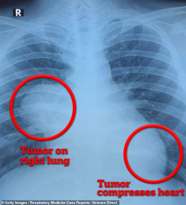 The patient's scan shows a mass on his right side, near his lungs, pressing against his heart (seen on the right side of the image, but it is the left side of his chest)