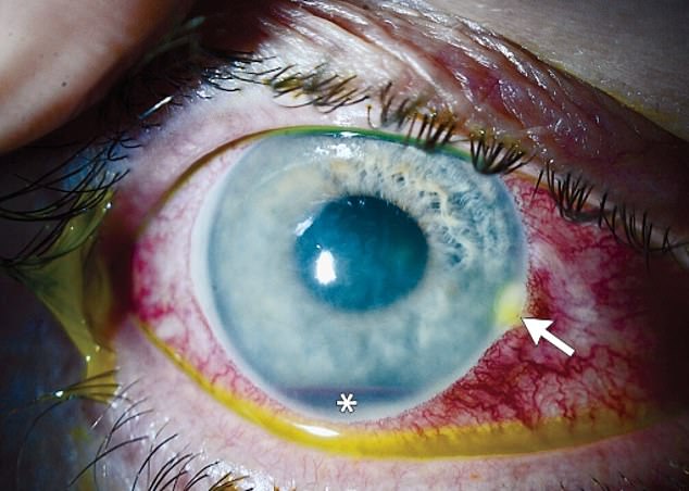 The side of the eye closest to the nose still had some of the stinger in it, which looked yellow after the eyes were painted, as indicated by an arrow in the image