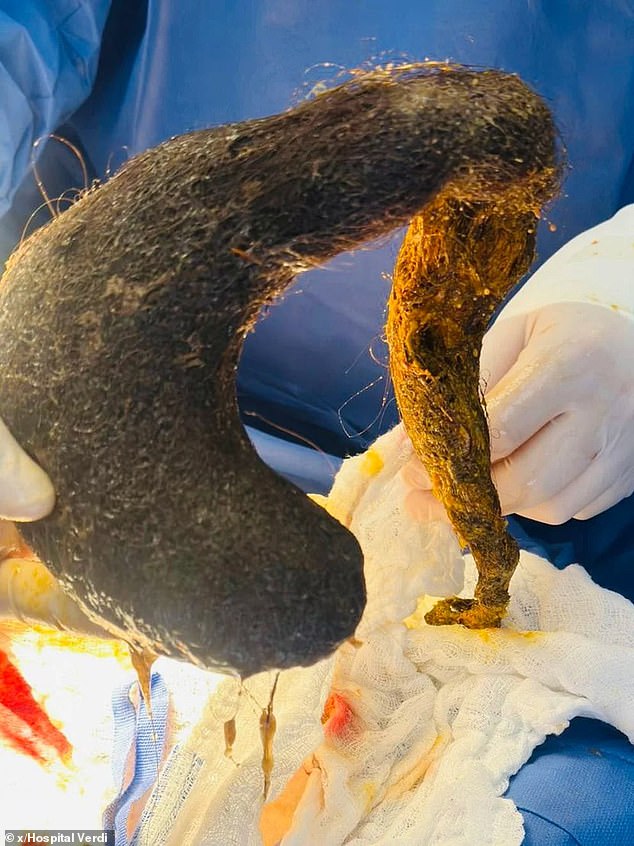 Two pounds of hair were removed from the abdomen of a 24-year-old female patient during a recent surgery at the Verdi Ceballos Balda General Hospital in Manabi, Ecuador