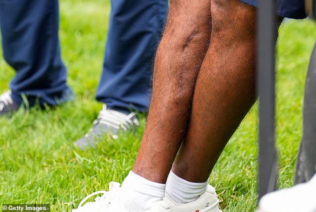 The extent of Tiger Woods' horrific leg injury has been revealed after the golden icon was photographed in shorts