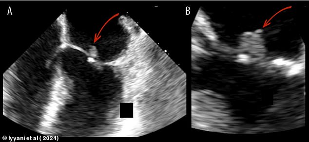 The scan above shows damage to an area of ​​the man's heart called the mitral valve, as indicated by arrows