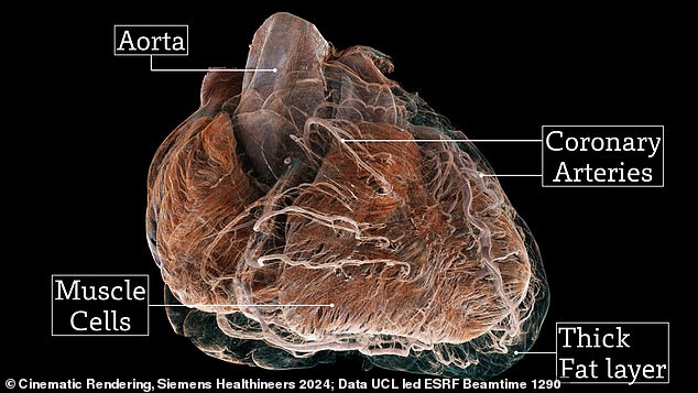 While the healthy heart has a clearly defined shape, the bad heart (pictured) is rounder, with shriveled vessels and muscle fibers