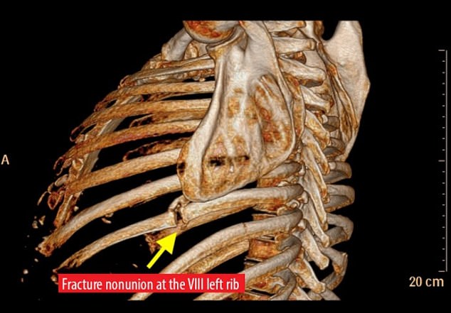 The man had broken his left 8th rib bone in half and the constant coughing was preventing it from healing. Bone tissue was pressing against a nerve in his chest, causing excruciating pain