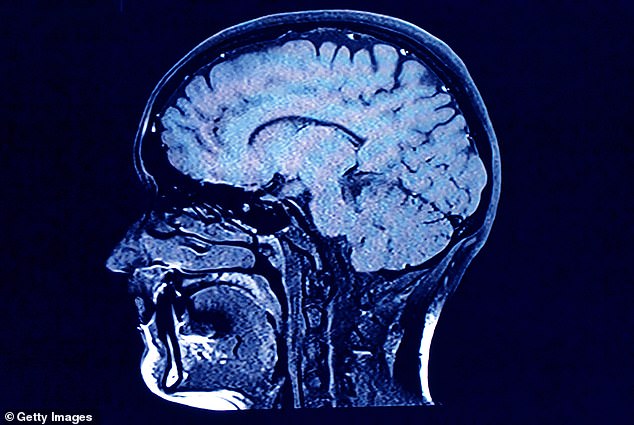 Scientists believe Alzheimer's likely results from an abnormal buildup of proteins — amyloid and tau — in and around brain cells.