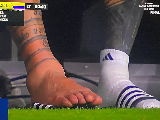 A new photo has revealed the true extent of the damage to Lionel Messi's ankle