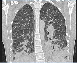 The scan of the patient's lungs showed semi-transparent spots that doctors initially mistook for signs of bacterial pneumonia