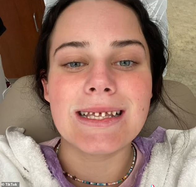 Caitlyn Weld, 22, shared the horror story of the dentist who left her with chipped teeth when she underwent a root canal