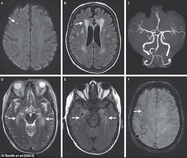 The above brain scans may indicate a stroke, damage to brain tissue, and narrowing of the blood vessels in the brain.